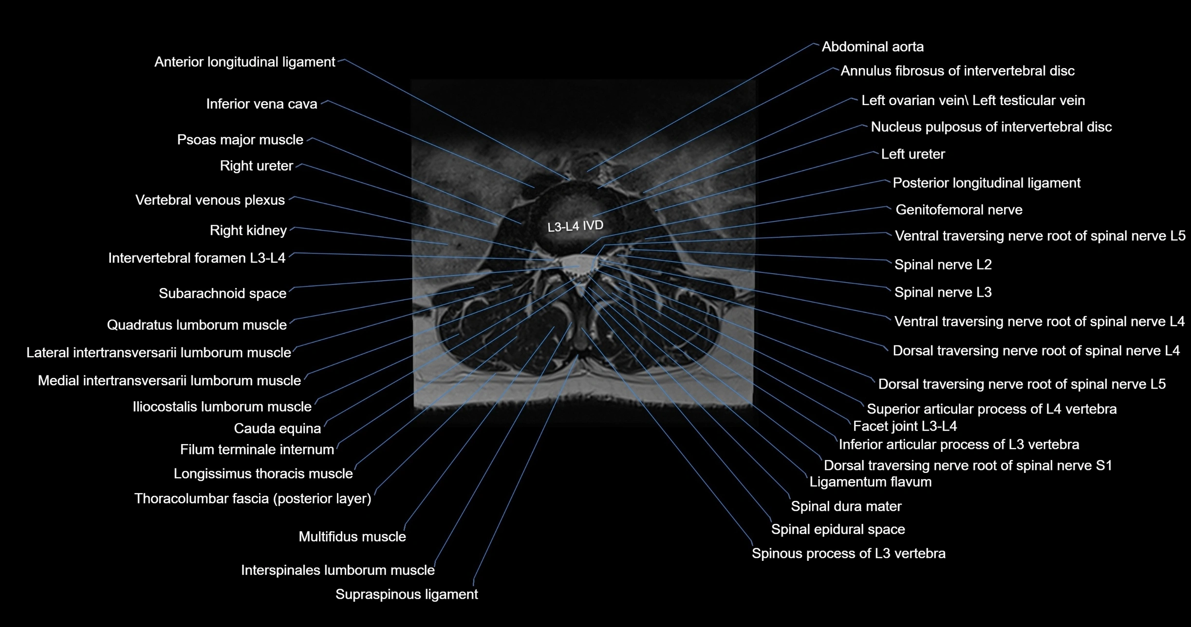 MRI lumbar spine axial cross sectional anatomy 3T radiology  image-img-00001-00026.webp
